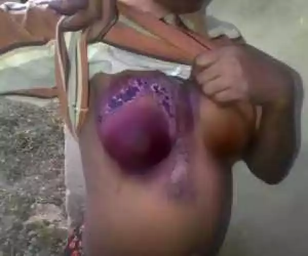 Graphic Photo: See What An Evil Madam Did To The Breast Of Her Househelp